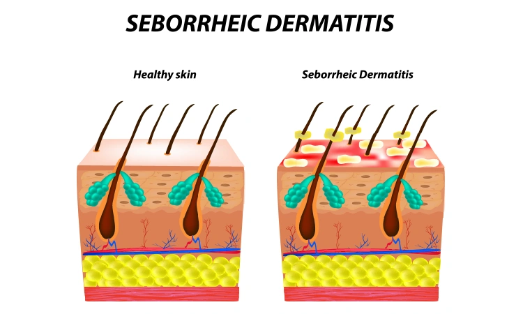 Natural options for seborrheic dermatitis treatment